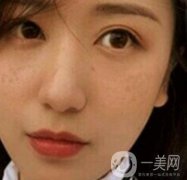 荊州市第三人民醫(yī)院整形美容科*祛斑果好嗎？收費(fèi)價(jià)格明細(xì)表一覽