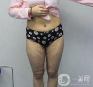 武漢市武昌醫(yī)院整形美容科價(jià)格表和吸脂瘦大腿案例精選圖公布