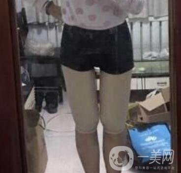 武漢市武昌醫(yī)院整形美容科價(jià)格表和吸脂瘦大腿案例精選圖公布