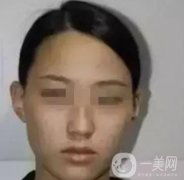 湖南省人民醫(yī)院點(diǎn)陣激光祛斑價(jià)格表及案例分享