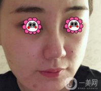 鼓樓醫(yī)院可以打*嗎？附案例恢復(fù)圖及整形價(jià)格表