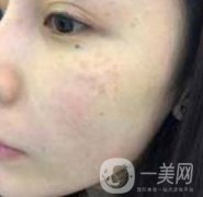 蘇州附一醫(yī)院可以激光祛斑嗎？案例圖及整形價(jià)格表分享