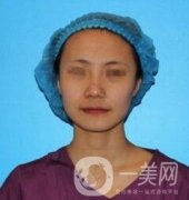 昆明惟美整形醫(yī)院脂肪填充全臉價格表和案例