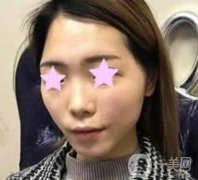 北大醫(yī)院整形美容科價(jià)格表，自體脂肪填充面部果怎么樣