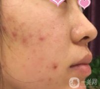 上海曙光醫(yī)院美容科價(jià)格表，*恢復(fù)前后一覽