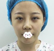 玫瑰醫(yī)院整形美容價(jià)格表，自體脂肪填充面部前后圖