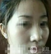 河南省人民醫(yī)院整形科價(jià)格表，自體脂肪填充面部案例展示