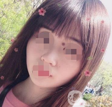 贛州附屬醫(yī)院整形美容科價格表及點痣案例公布，速覽