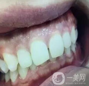 龍崗中心醫(yī)院整牙多少錢？價(jià)格表2020收費(fèi)明細(xì)公開一覽