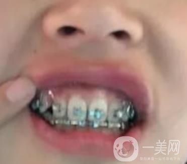 龍崗中心醫(yī)院整牙多少錢？價(jià)格表2020收費(fèi)明細(xì)公開一覽
