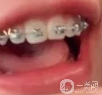 龍崗中心醫(yī)院整牙多少錢？價(jià)格表2020收費(fèi)明細(xì)公開一覽