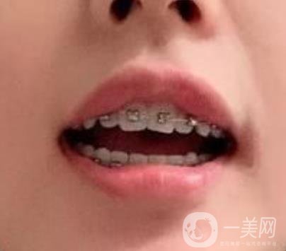龍崗中心醫(yī)院整牙多少錢？價(jià)格表2020收費(fèi)明細(xì)公開一覽