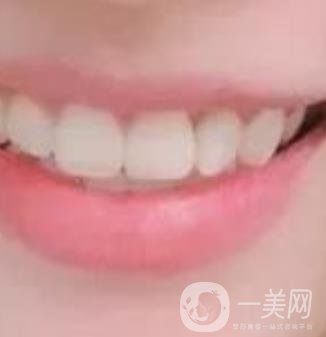 龍崗中心醫(yī)院整牙多少錢？價(jià)格表2020收費(fèi)明細(xì)公開一覽
