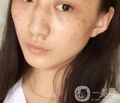 安醫(yī)一附院整形外科價格表2020版，還有激光祛斑案例