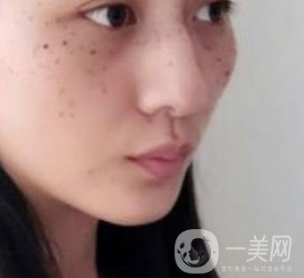 安醫(yī)一附院整形外科價格表2020版，還有激光祛斑案例