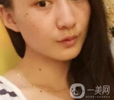 安醫(yī)一附院整形外科價格表2020版，還有激光祛斑案例