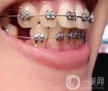 北京市海淀醫(yī)院口腔科價格表2020更新，附牙齒矯正案例