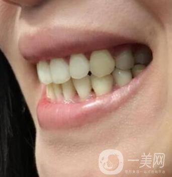 北京市海淀醫(yī)院口腔科價格表2020更新，附牙齒矯正案例