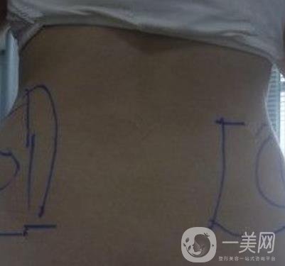 襄陽市第一人民醫(yī)院整形美容科吸脂瘦肚子多少錢？價(jià)格表整形日記一覽