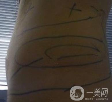襄陽市第一人民醫(yī)院整形美容科吸脂瘦肚子多少錢？價(jià)格表整形日記一覽