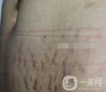 陽煤集團(tuán)總醫(yī)院整形美容科祛妊娠紋恢復(fù)記錄，內(nèi)附價格表
