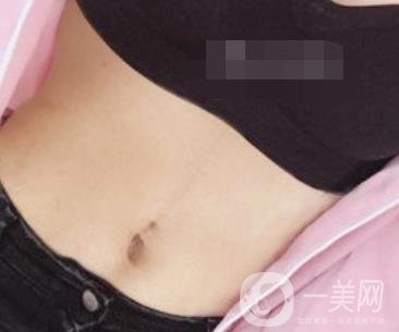 陽煤集團(tuán)總醫(yī)院整形美容科祛妊娠紋恢復(fù)記錄，內(nèi)附價格表