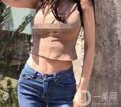 陽煤集團(tuán)總醫(yī)院整形美容科祛妊娠紋恢復(fù)記錄，內(nèi)附價格表