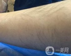 山東省立醫(yī)院整形科激光脫毛果好嗎?價(jià)格收費(fèi)標(biāo)準(zhǔn)表一覽