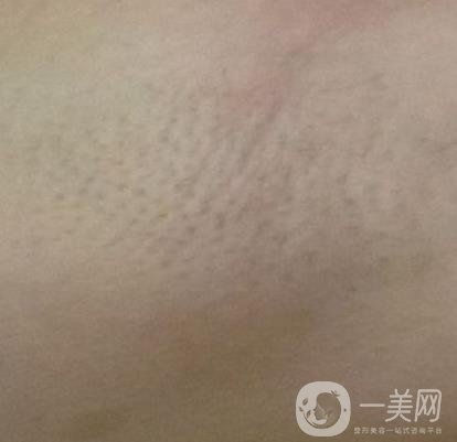 山東省立醫(yī)院整形科激光脫毛*果好嗎?價(jià)格收費(fèi)標(biāo)準(zhǔn)表一覽