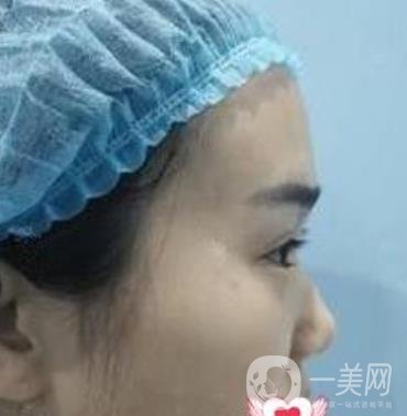 上海市第一人民醫(yī)院整形科隆鼻大概要多少錢?附價格明細(xì)一覽表