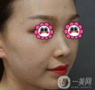 沈陽杏林崔昌墉做鼻子怎么樣？2020整形價格表一覽