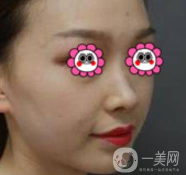 沈陽杏林崔昌墉做鼻子怎么樣?2020整形價格表一覽