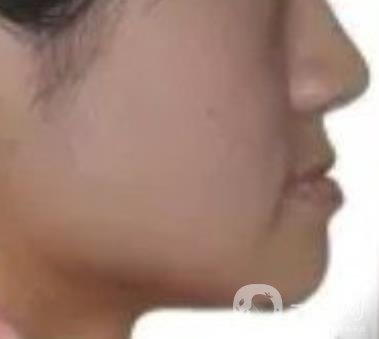 鄭大一附院口腔正畸怎么樣?附項目價格表及案例圖