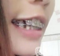 桂林美奧口腔醫(yī)院價格表全新版，附牙齒矯正案例