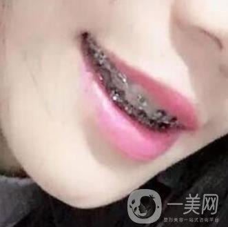 桂林美奧口腔醫(yī)院價格表全新版，附牙齒矯正案例