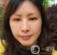 沈陽軍區(qū)總醫(yī)院整形外科價格表，附雙眼皮真實案例