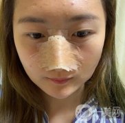 重慶新橋醫(yī)院整形科價格表，隆鼻案例分享