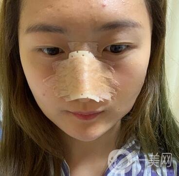 重慶新橋醫(yī)院整形科價(jià)格表，隆鼻案例分享