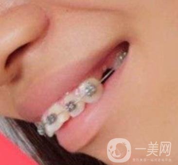 復旦大學附屬兒科醫(yī)院口腔科做牙齒矯正多少錢？價格表明細一覽