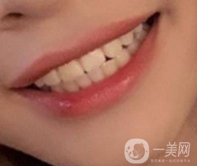 復旦大學附屬兒科醫(yī)院口腔科做牙齒矯正多少錢？價格表明細一覽
