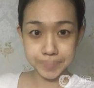 重慶醫(yī)科大學(xué)附屬第一醫(yī)院整形科價格價目表，附雙眼皮果圖