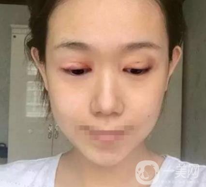 重慶醫(yī)科大學(xué)附屬第一醫(yī)院整形科價(jià)格價(jià)目表，附雙眼皮*果圖