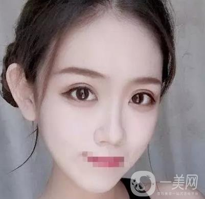 重慶醫(yī)科大學(xué)附屬第一醫(yī)院整形科價(jià)格價(jià)目表，附雙眼皮*果圖