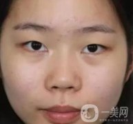 淮安第一人民醫(yī)院割雙眼皮怎樣？真人案例及整形價格表分享