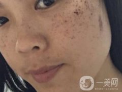 北京星美整形醫(yī)院祛斑如何？附案例和價格表