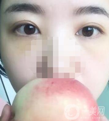 長(zhǎng)海醫(yī)院去眼袋