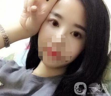 長(zhǎng)海醫(yī)院去眼袋