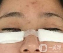 協(xié)和醫(yī)院整形美容科價格表，附去眼袋手術(shù)果圖分享