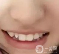 良鄉(xiāng)優(yōu)貝口腔醫(yī)院價格表，整牙恢復(fù)前后照