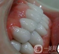 杭州格萊美醫(yī)院整牙價格表，看牙齒矯正術(shù)后果實拍